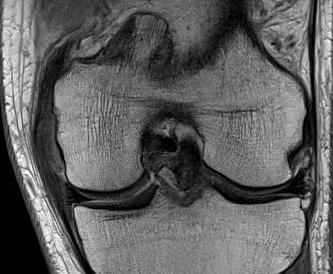 MCL Chronic Femoral Thickening